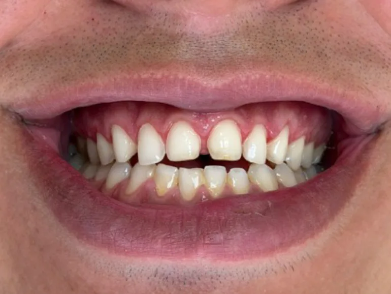 Antes: dentes pequenos e com espaços entre eles