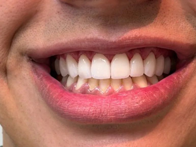 Depois: o mesmo sorriso com facetas de porcelana