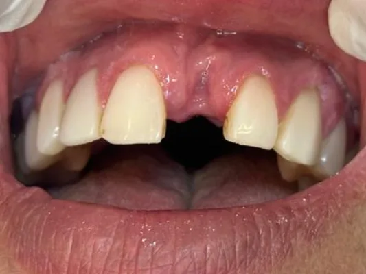 Antes: espaço de um dente da frente perdido