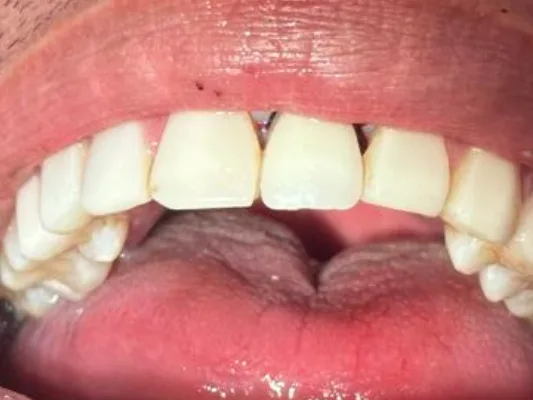 Depois: o mesmo sorriso com o implante no lugar do dente