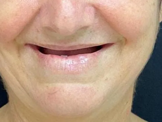 Antes: paciente sem dentes superiores, sorriso com a boca vazia