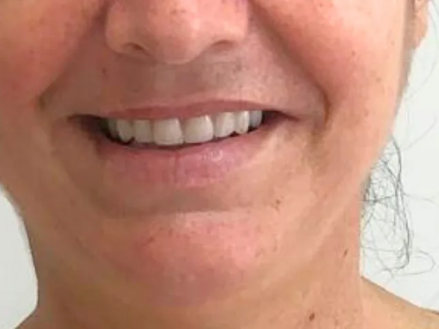 Depois: a mesma paciente sorrindo com prótese protocolo fixa